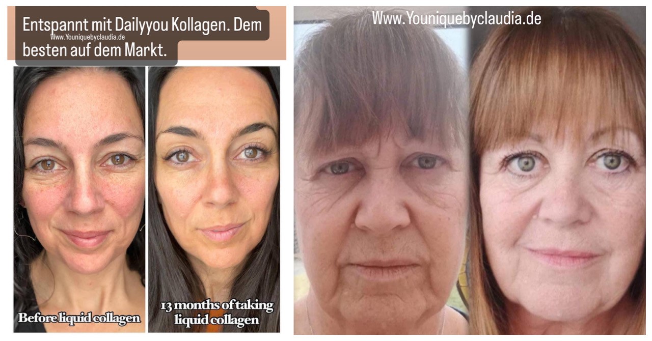 Verwunderlich Kollagen Haare Vorher Nachher Bilder